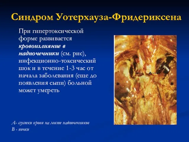 Синдром Уотерхауза-Фридериксена При гипертоксической форме развивается кровоизлияние в надпочечники (см. рис),