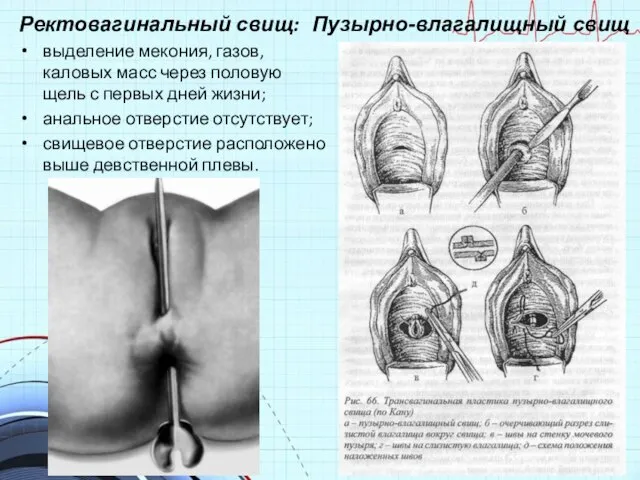 Ректовагинальный свищ: выделение мекония, газов, каловых масс через половую щель с