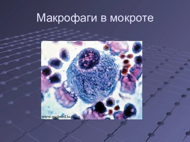 Макрофаги в мокроте