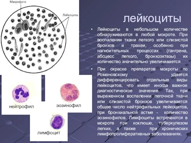 лейкоциты Лейкоциты в небольшом количестве обнаруживаются в любой мокроте. При воспалении