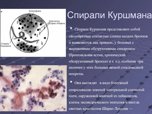 Спирали Куршмана Спирали Куршмана представляют собой своеобразные слизистые слепки мелких бронхов