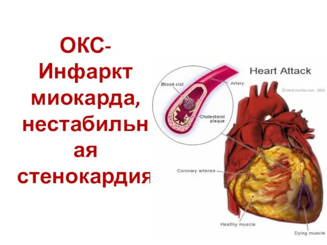 ОКС- Инфаркт миокарда, нестабильная стенокардия