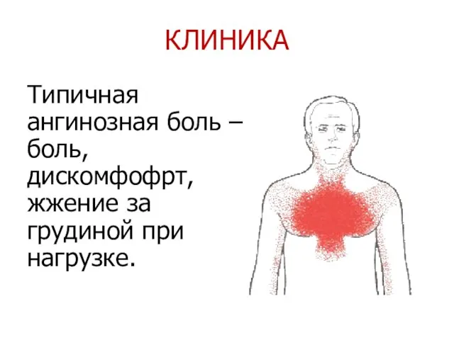 КЛИНИКА Типичная ангинозная боль – боль, дискомфофрт, жжение за грудиной при нагрузке.