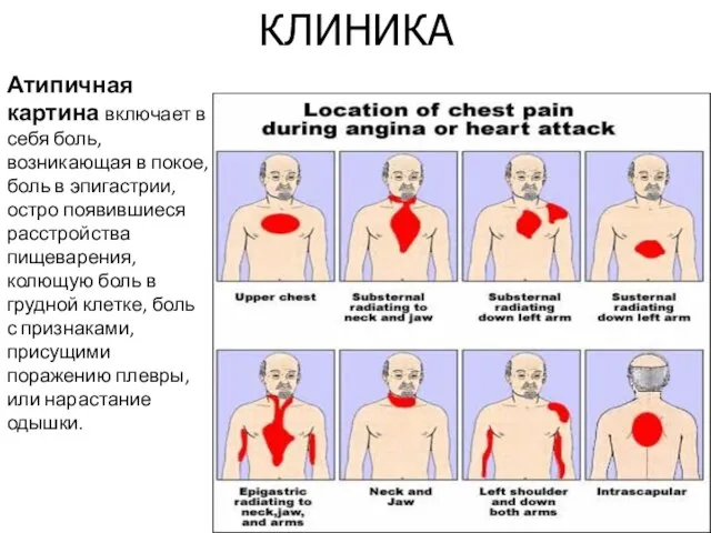 КЛИНИКА Атипичная картина включает в себя боль, возникающая в покое, боль