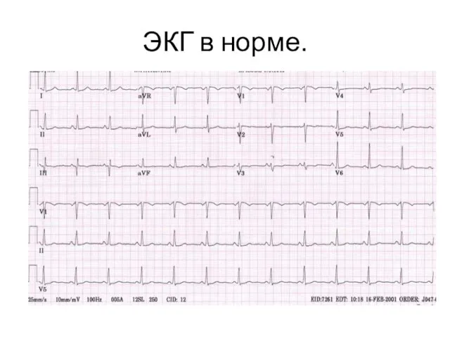 ЭКГ в норме.