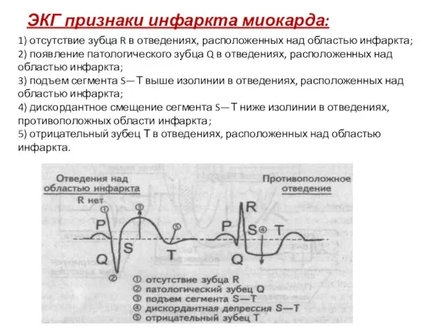 ЭКГ признаки инфаркта миокарда: 1) отсутствие зубца R в отведениях, расположенных