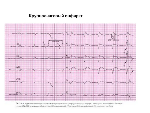 Крупноочаговый инфаркт