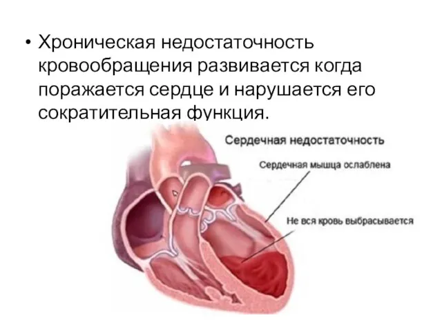 Хроническая недостаточность кровообращения развивается когда поражается сердце и нарушается его сократительная функция.