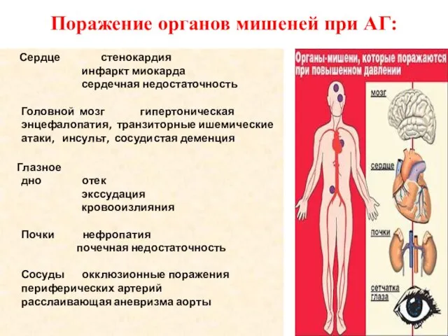 Поражение органов мишеней при АГ: Сердце стенокардия инфаркт миокарда сердечная недостаточность