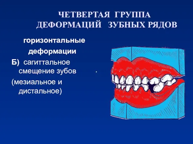 ЧЕТВЕРТАЯ ГРУППА ДЕФОРМАЦИЙ ЗУБНЫХ РЯДОВ горизонтальные деформации Б) сагиттальное смещение зубов (мезиальное и дистальное)