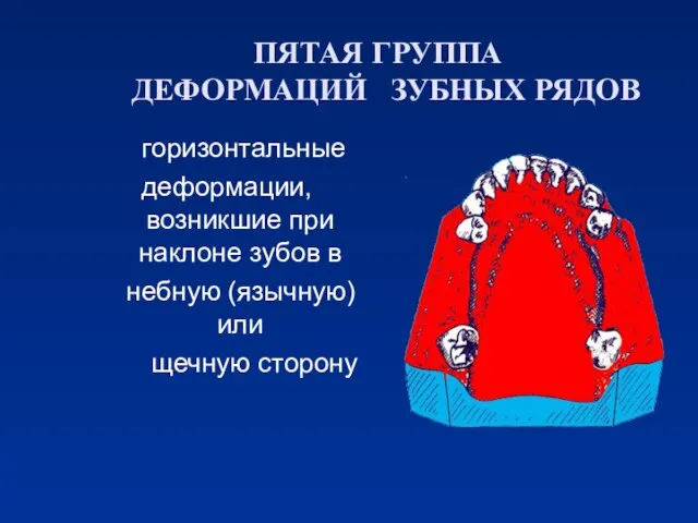 ПЯТАЯ ГРУППА ДЕФОРМАЦИЙ ЗУБНЫХ РЯДОВ горизонтальные деформации, возникшие при наклоне зубов