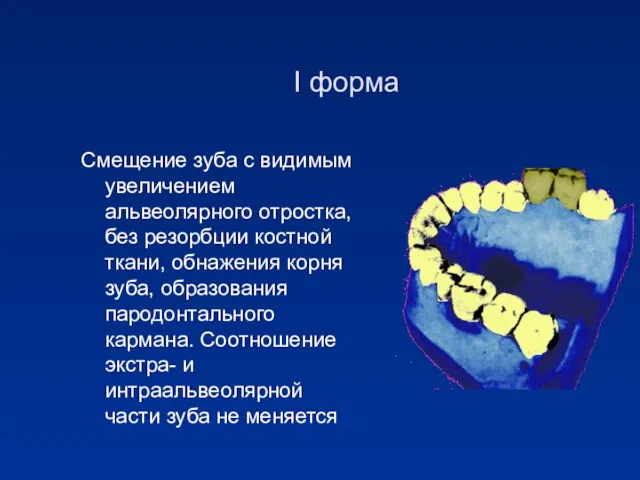 I форма Смещение зуба с видимым увеличением альвеолярного отростка, без резорбции