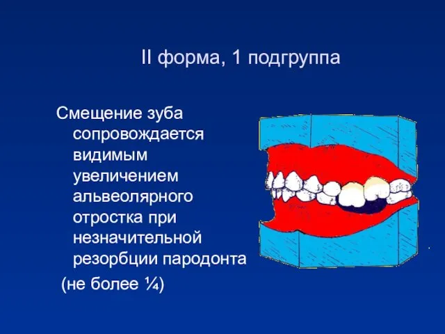 II форма, 1 подгруппа Смещение зуба сопровождается видимым увеличением альвеолярного отростка