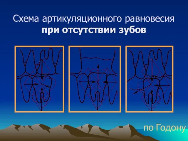 Схема артикуляционного равновесия при отсутствии зубов по Годону