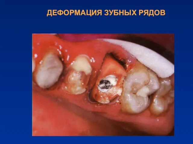 ДЕФОРМАЦИЯ ЗУБНЫХ РЯДОВ