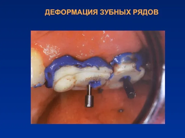 ДЕФОРМАЦИЯ ЗУБНЫХ РЯДОВ