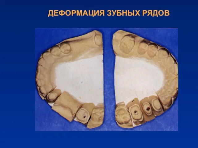 ДЕФОРМАЦИЯ ЗУБНЫХ РЯДОВ