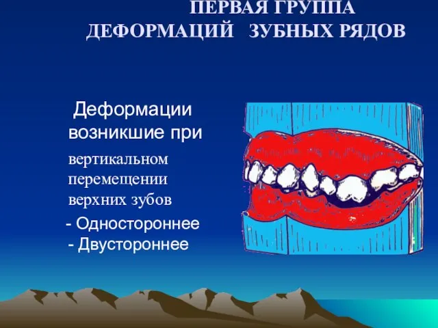 ПЕРВАЯ ГРУППА ДЕФОРМАЦИЙ ЗУБНЫХ РЯДОВ Деформации возникшие при вертикальном перемещении верхних зубов - Одностороннее - Двустороннее