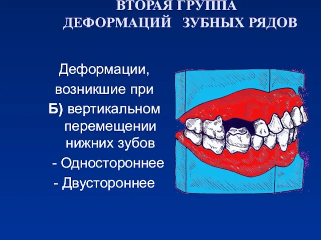 ВТОРАЯ ГРУППА ДЕФОРМАЦИЙ ЗУБНЫХ РЯДОВ Деформации, возникшие при Б) вертикальном перемещении