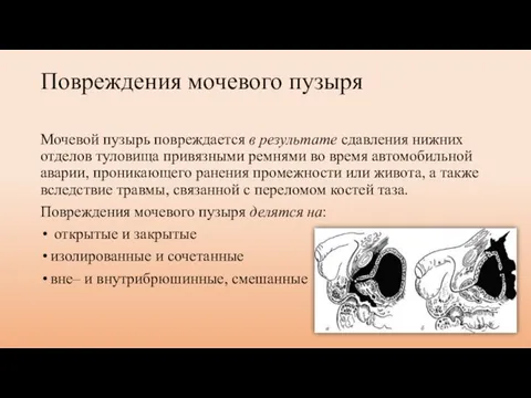 Повреждения мочевого пузыря Мочевой пузырь повреждается в результате сдавления нижних отделов