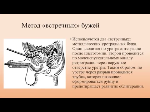 Метод «встречных» бужей Используются два «встречных» металлических уретральных бужа. Один вводится