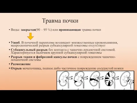 Травма почки Виды: закрытая(90 – 95 ℅) или проникающая травма почки