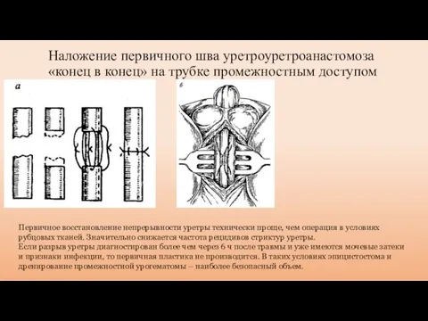 Наложение первичного шва уретроуретроанастомоза «конец в конец» на трубке промежностным доступом