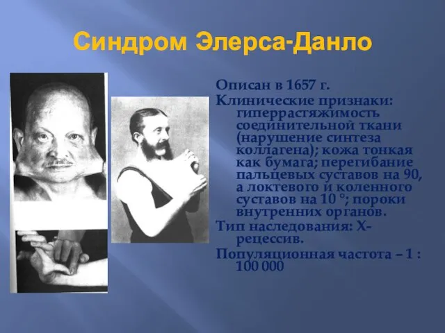 Синдром Элерса-Данло Описан в 1657 г. Клинические признаки: гиперрастяжимость соединительной ткани