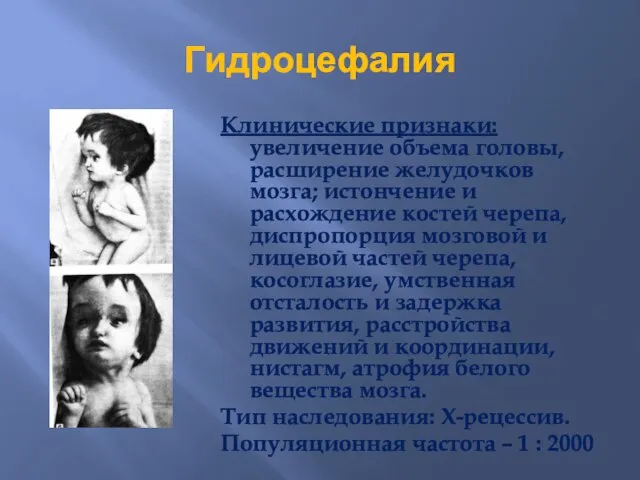 Гидроцефалия Клинические признаки: увеличение объема головы, расширение желудочков мозга; истончение и