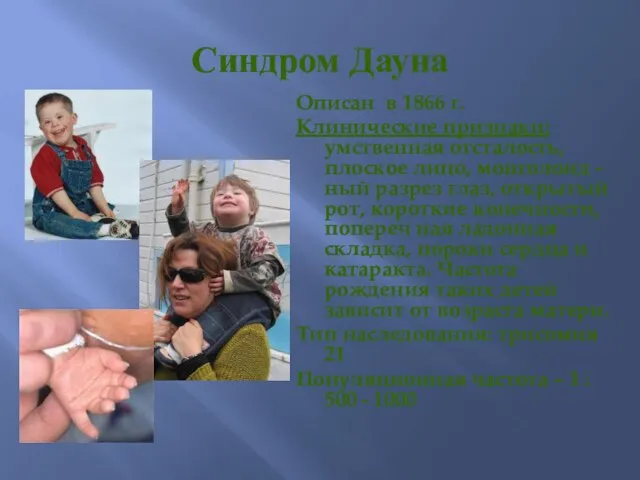 Синдром Дауна Описан в 1866 г. Клинические признаки: умственная отсталость, плоское