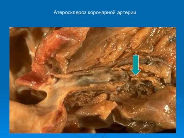 Атеросклероз коронарной артерии
