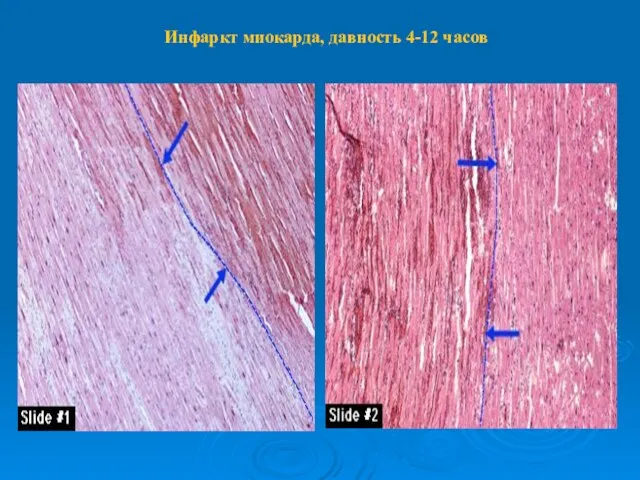 Инфаркт миокарда, давность 4-12 часов