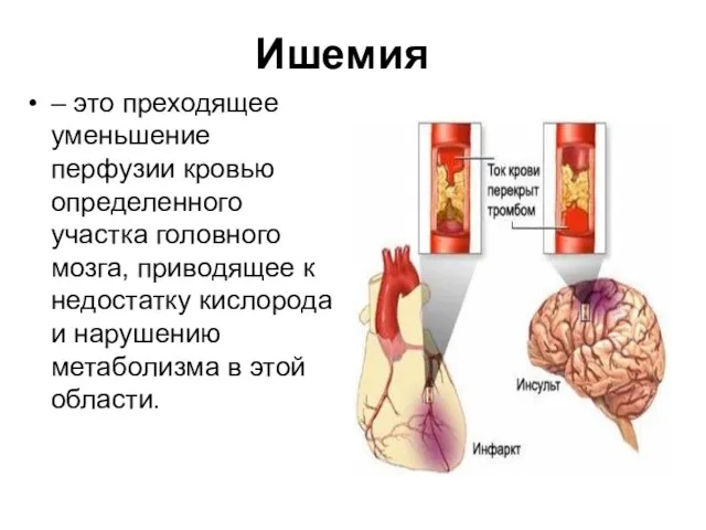 Ишемия – это преходящее уменьшение перфузии кровью определенного участка головного мозга,