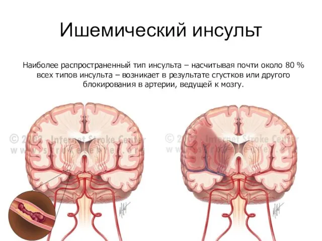 Ишемический инсульт Наиболее распространенный тип инсульта – насчитывая почти около 80