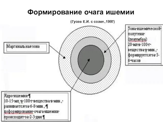 Формирование очага ишемии (Гусев Е.И. с соавт.,1997)