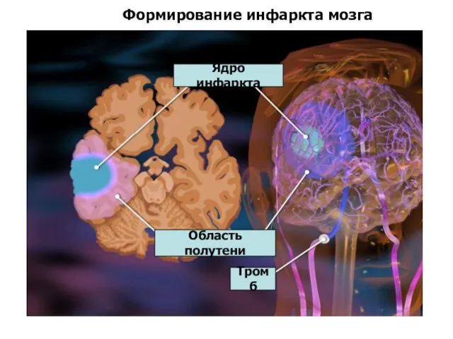 Формирование инфаркта мозга Ядро инфаркта Область полутени Тромб