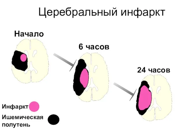 Церебральный инфаркт Инфаркт Ишемическая полутень Начало 6 часов 24 часов