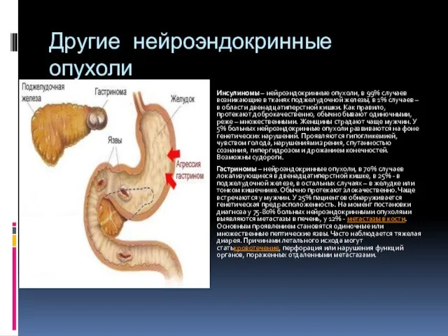 Другие нейроэндокринные опухоли Инсулиномы – нейроэндокринные опухоли, в 99% случаев возникающие