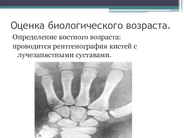 Оценка биологического возраста. Определение костного возраста: проводится рентгенография кистей с лучезапястными суставами.