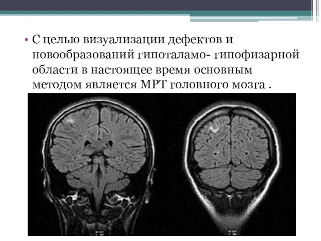 С целью визуализации дефектов и новообразований гипоталамо- гипофизарной области в настоящее