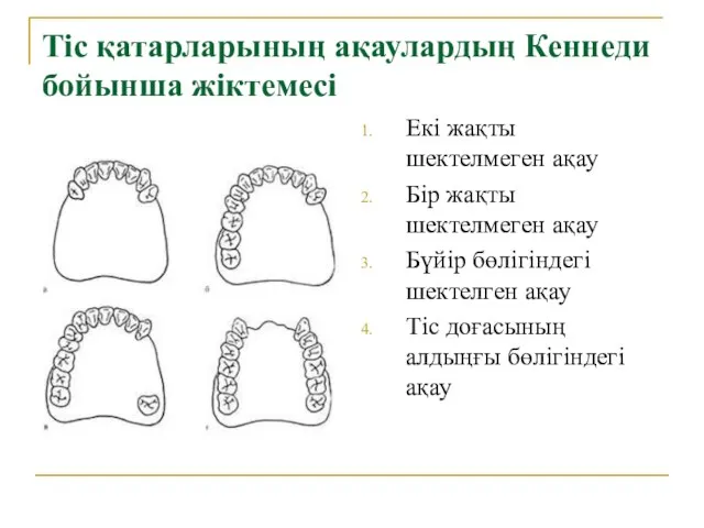 Тіс қатарларының ақаулардың Кеннеди бойынша жіктемесі Екі жақты шектелмеген ақау Бір