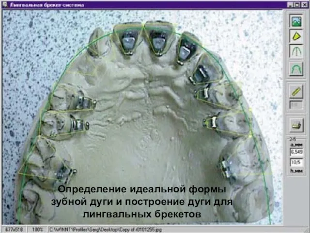 Медицинские информационные системы Определение идеальной формы зубной дуги и построение дуги для лингвальных брекетов