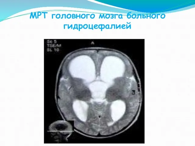 МРТ головного мозга больного гидроцефалией
