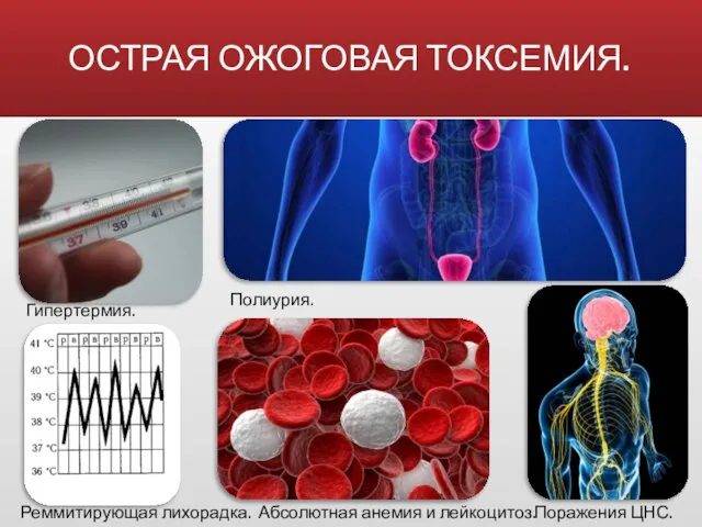 ОСТРАЯ ОЖОГОВАЯ ТОКСЕМИЯ. Гипертермия. Полиурия. Реммитирующая лихорадка. Поражения ЦНС. Абсолютная анемия и лейкоцитоз.