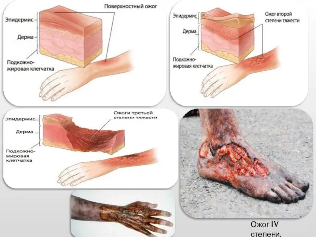 Ожог IV степени.