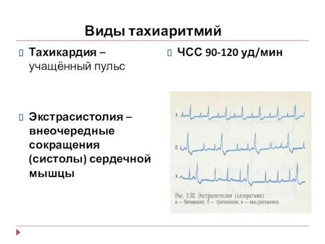 Виды тахиаритмий Тахикардия – учащённый пульс Экстрасистолия – внеочередные сокращения (систолы) сердечной мышцы ЧСС 90-120 уд/мин