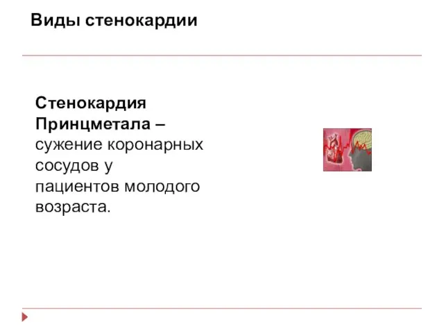 Виды стенокардии Стенокардия Принцметала – сужение коронарных сосудов у пациентов молодого возраста.