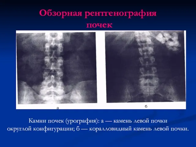 Обзорная рентгенография почек Камни почек (урография): а — камень левой почки