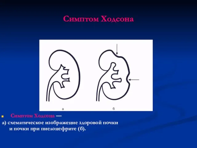 Симптом Ходсона Симптом Ходсона — а) схематическое изображение здоровой почки и почки при пиелонефрите (б).