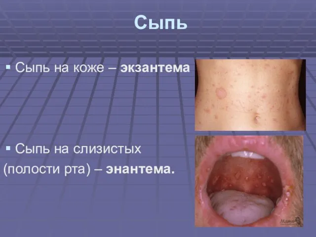 Сыпь Сыпь на коже – экзантема Сыпь на слизистых (полости рта) – энантема.